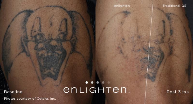Laser Tattoo Removal Laser Tattoo Removal — New York City