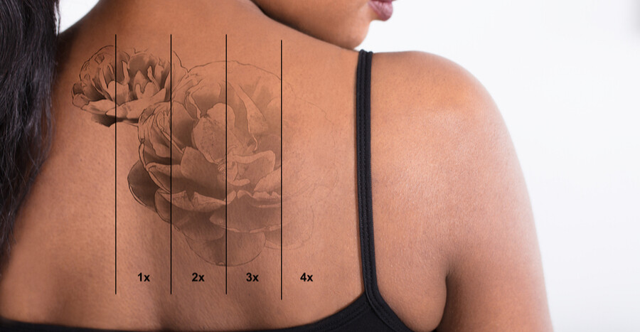 Make Appointment - Laser Tattoo Removal — New York City